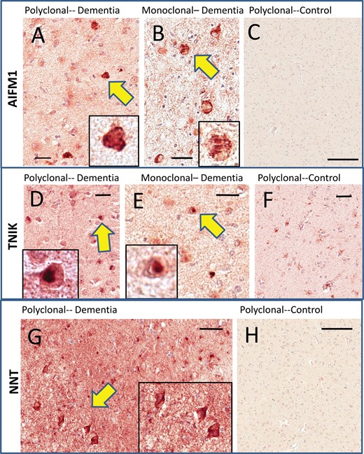 Immunohistochemistry for TNIK, AIFM1, and NNT in human amygdalae. Two different AIFM1 antibodies (A, B) were used and they showed similar results with intracellular-immunoreactive structures that resembled inclusion bodies (see arrows and insets at higher magnification) in cases with cognitive impairment. Immunoreactivity was very sparse in cognitively intact persons (C). Two different TNIK antibodies (D, E) were used and they showed similar results. These resembled Lewy bodies in terms of histopathologic appearance (see insets), and tended to be present in cases with previously diagnosed Lewy body pathology. Control cases showed relatively sparse staining (F). The NNT antiserum showed scattered immunoreactive cells that were more equivocal in terms of inclusion body-type histomorphology (G). However, the background staining for the cases with cognitive impairments was considerably higher than for the cases with intact cognition, which showed only light immunoreactivity (H). Scale bars: A = 35 μm; B = 20 μm; C = 500 μm; D = 30 μm; E = 25 μm; F = 60 μm; G = 50 μm; H = 500 μm.