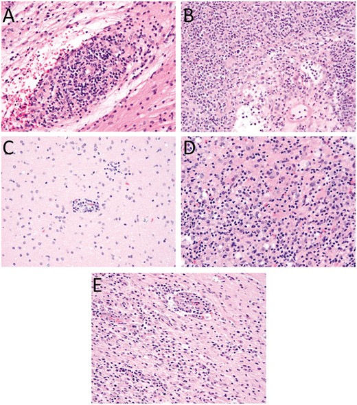 Histological features present in brain biopsies. (A) Biopsy of the cerebellum from Patient 1 reveals a moderate perivascular, predominantly lymphocytic infiltrate. Lymphocytes infiltrate into small blood vessel walls causing some structural alteration and are associated with surrounding parenchymal edema. (B) Biopsy of the thalamus from Patient 1 shows a dense, predominantly lymphocytic perivascular and parenchymal inflammatory infiltrate with some structural alteration of the blood vessel walls and surrounding edema. (C) The initial frontal lobe biopsy from Patient 2 shows mild focal perivascular inflammatory infiltrates. (D) Frontal lobe biopsy of Patient 2 in the setting of recurrent disease shows severe destructive parenchymal lesions. (E) Similar diffuse parenchymal chronic inflammatory infiltrates are present in the frontal lobe biopsy of Patient 3. All images are stained with H&E and were taken with a 40× objective.