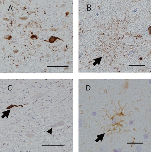 Tau pathology of Cases 1 and 2. Case 1: AT8-positive NFTs (A, arrow) in the locus ceruleus of the pons and astrocytic inclusions of tau were observed in the amygdala (B, arrow). Case 2: Immunostaining with the AT8 antibody revealed NFTs (C, arrow) and granular NCIs (C, arrowhead) in the anterior horn of the cervical cord, and astrocytic inclusions of tau in the amygdala (D, arrow). Scale bars: A, C = 100 μm; B, D = 25 μm.