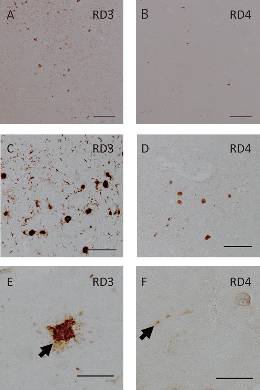 RD3 and RD4 pathology of 3 cases. In the hippocampus entorhinal cortex of Case 2, RD3 (A) immunoreactivity of NFTs and neuropil threads predominated compared with RD4 (B). In the pontine tegmentum of Case 1, RD3-positive NFTs (C) were more frequently seen than RD4-positive NFTs (D). In the anterior horn of the cervical spine of Case 3, the RD3 antibody labeled NFTs (E) whereas the RD4 antibody occasionally labeled neurites (f). Scale bars: A, B = 200 μm; C, D = 100 μm; E, F = 50 μm.