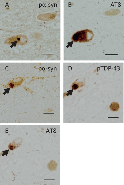 Immunohistochemistry using serial sections in Case 3. Consecutive sections revealed phosphorylated α-synuclein (pα-syn)-positive inclusions (A) and AT8-positive NFTs (B) in the same neuron in the pons, and pα-syn-positive inclusions (C), pTDP-43-positive inclusions (D) and AT8-positive NFTs (E) in the same neuron in the midbrain. Scale bars: A–E = 25 μm.