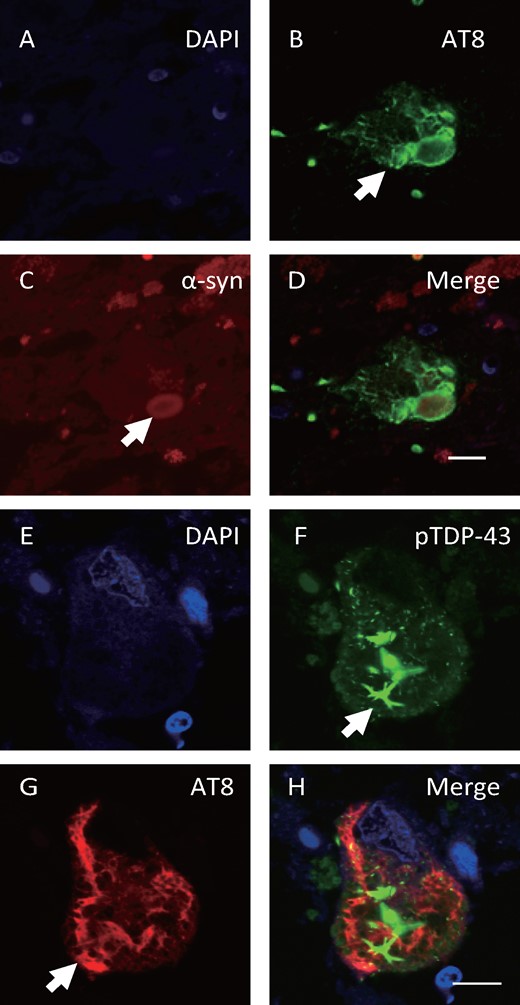 Double-labeling immunofluorescence for AT8, α-synuclein and pTDP-43 in Case 3. Double immunofluorescence staining demonstrated AT8-positive NFTs (B, arrow, green) and α-synuclein-positive (C, arrow, red) Lewy bodies in the same neuron in the pons, and pTDP-43-positive cytoplasmic inclusions (F, arrow, green) and AT8-positive NFTs (G, arrow, red) in the same neuron of the midbrain. Scale bars: A–H = 10 μm.
