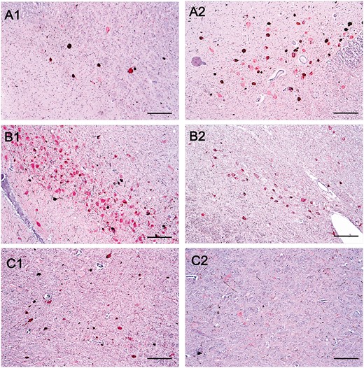 Comparison of histopathological features between Alzheimer disease (AD), corticobasal degeneration (CBD) and progressive supranuclear palsy (PSP). (A) Histological slides containing the locus coeruleus immunostained for phospho-tau and TH of an AD case (A1) and in a PSP case (A2). (B) Histological slides containing the substantia nigra immunostained for phospho-tau and TH of an AD case (B1) and a CBD case (B2). (C) Histological slides containing the gigantocellular nucleus in a PSP case (C1) and an AD case (C2). Scale bar: 25 µm.