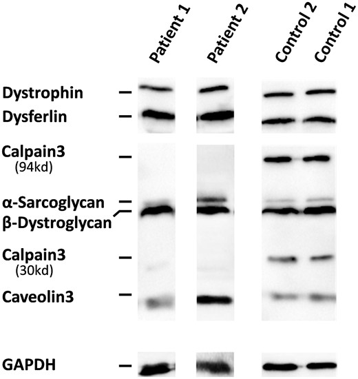 多重免疫印迹分析。与对照组相比，多重免疫印迹法的蛋白质分析显示两名患者中完全没有钙蛋白酶-3。Dystrophin（423 kDa）、dysferrin（200 kD）、α-肌多糖（50 kDa。GAPDH被用作负荷控制。