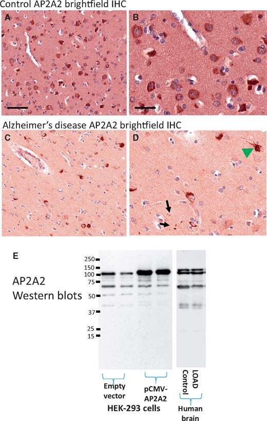 Brightfield immunohistochemical staining of AP2A2 in human brain sections. Shown are representative results from staining of temporal neocortex. Panels (A) and (B) show results from a nondemented aged subject with minimal Alzheimer-type pathology. Panel (A) and (B; higher magnification) show the relatively even, neuronal staining for AP2A2. Panels (C) and (D) show representative results from a demented subject with severe Alzheimer’s disease pathology. Note that the staining pattern of AP2A2 is here reminiscent of neurofibrillary tangles (green arrowhead), as well as some scattered, darkly AP2A2-immunoreactive structures in the neuropil (black arrows). Scale bars: A, C = 200 microns; B, D = 25 microns. Panel (E) shows the results of Western blots using the same AP2A2 antiserum—immunoblots of HEK-293 cell extracts are shown. This antiserum recognizes a prominent band at the predicted (∼104 kDa) size that is augmented by transfection with a pCMV-AP2A2 plasmid. The human brain extracts (shown here are Western blots from the cerebellum of 1 control and 1 LOAD brain) stained a similar banding pattern.