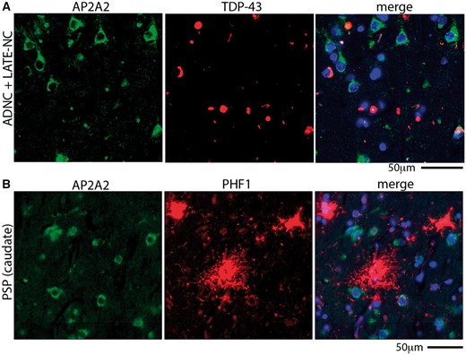 Unlike in cases with LOAD pathology, AP2A2 does not colocalize extensively with phospho-TDP-43 in brains with limbic-predominant age-related TDP-43 proteinopathy neuropathologic changes (LATE-NC), nor with pTau in progressive supranuclear palsy (PSP) brains. (A) A representative example of AP2A2 and phospho-TDP-43 staining using epifluorescence microscopy shows the lack of colocalization of AP2A2 with phospho-TDP-43 in a brain with both AD neuropathologic changes (ADNC) and LATE-NC. (B) AP2A2 was also not colocalized with pTau (immunostained with antibody PHF1) in the caudate nucleus of subjects with autopsy-proven PSP. Quantitative analyses of these results are shown in Supplementary Data Figures S12 and S13.