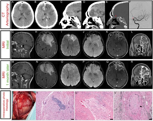 (A) CT showed cortico-subcortical hypodensity of the left frontal lobe which crossed the midline and affected the right frontal lobe. The lesion exerted mass effect with 6 mm midline shift to the right and collapse of the frontal and temporal horns of the left lateral ventricle. (B) Diffuse leptomeningeal enhancement was observed after contrast administration. (C–E) Severe bony erosion in the intranasal cavity and anterior skull base was visualized on the bone windows of the same CT scan. Sagittal CT images showed cribriform plate destruction, which resulted in left nasal cavity and anterior cranial fossa connection (E). We also detected the occupation of several sinuses in relation to chronic sinupathy. (F) Cerebral angiogram demonstrated a focal narrowing at the supraclinoid internal carotid artery (oblique view). (G–L) Initial MRI. (G) The lesion was hypointense on T1-weighted images (T1WI). (H) T2-weighted images (T2WI) hyperintensity involved both frontal lobes, the left insular cortex and left hippocampus. The hyperintensity affected cortical and subcortical parenchyma, exerted mass effect of the ventricular system, shifting the midline 13 mm to the right. (I) Diffusion-weighted imaging (DWI) revealed the presence of signal-intensity abnormality mostly on cortical areas. (J) Hypointense lesions on susceptibility-weighted imaging (SWI) were also observed, suggesting hemorrhagic events. (K–L) Gadolinium-based contrast-enhanced images depicted mild left fronto-basal parenchyma enhancement and a strong diffuse leptomeningeal enhancement, in contact with the cribriform plate. (M–R) A second MRI was performed one month later. (M) T1WI showed augmented necrotic/cystic brain areas. (N) T2WI hyperintensity was slightly diminished on the left hemisphere while it was augmented on the right frontal lobe. (O) Signal intensity on DWI was markedly reduced compared with the previous study. (P) Hypointense lesions on SWI were stable one month later. (Q–R) The new imaging study revealed a marked increase in parenchymal and meningeal contrast enhancement. (S) Intraoperative photograph. A left frontal craniotomy was performed. The dura mater was opened in an X-shaped incision exposing brain. Brain parenchyma was firmer than normal, and necrotic areas were observed. (T–V) Histopathologic features of brain biopsy. (T) Dense polymorphic perivascular and transmural infiltrate, surrounded by reactive astrogliosis (H&E). (U) The lumen of an artery is occluded by an organized thrombus, which is partially recanalized (H&E). (V) Black arrow points to disruption of the internal elastic lamina of the vessel wall (Van Gieson stain). Scale bar: 100 µm.