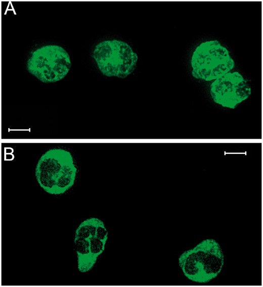 Indirect immunofluorescence for anti-neutrophil cytoplasmic antibodies (ANCA). (A) Ethanol-fixed neutrophils. Atypical ANCA pattern with a granular cytoplasmic staining and perinuclear reinforcement. (B) Formalin-fixed neutrophils. Homogeneous cytoplasmic staining, similar to typical cytoplasmic ANCA pattern. Titration, 1:40. Scale bar: 10 µm. The sample was diluted in phosphate-buffered saline (1:40). Then, the diluted sample was incubated with the fixed neutrophils in ethanol and formalin for 30 minutes at room temperature. After that, the sample was washed 3 times with PBS for 5 minutes. Once the slice was dried, it was incubated with the secondary antibody (antihuman IgG-FITC, Aesku Diagnostics, Wendelsheim, Germany). The slide was then washed as mentioned before.