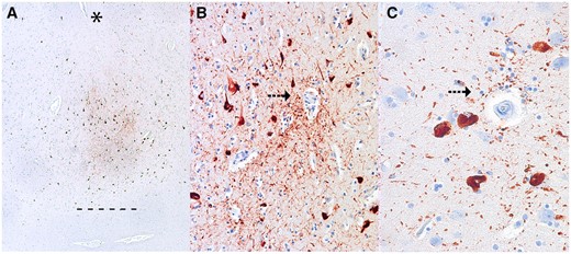 Representative images of the pathognomonic perivascular lesion of chronic traumatic encephalopathy. Ten-μm paraffin-embedded tissue sections immunostained for phosphorylated tau (AT8) (Pierce Endogen). (A) Shows several perivascular clusters of p-tau-positive NFTs and neurites at the depths of the sulcus. Magnification: x40. The depth of the sulcus is indicated with an asterisk (*), the junction between gray and white matter is demarcated as a series of short lines (-). (B, C) There is markedly increased density of dotlike p-tau immunoreactive neurites surrounding the vessel wall (arrows) and the surrounding NFTs show clear vasculocentricity. Magnifications: B, x200, C, x400.