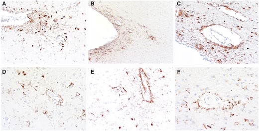 Representative images of ARTAG that might be mistaken for CTE. Ten-μm paraffin-embedded tissue sections immunostained for phosphorylated tau (AT8) (Pierce Endogen). (A, B) P-tau-immunoreactive thorn-shaped astrocytes found at glial limitans at the depths of the sulcus are features of ARTAG that may be found in CTE, but are not diagnostic for CTE. Magnifications: A, x200, B, x100. (C) Perivascular clusters of p-tau positive astrocytes surrounding thin-walled vessel in the superficial regions of the sulcal depths also represent ARTAG. Magnification: x200. (D–F) Common forms of perivascular p-tauimmunoreactive astrocytic pathology (ARTAG) in white matter. Magnification: x200.