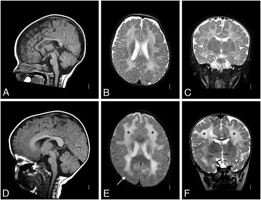 Brain MRI of Patient 1. A T2-weighted brain MRI at 4 months of age was interpreted as normal (A: sagittal, B: coronal, and C: axial); the white matter signal was developmentally appropriate. By 2 years of age (D: sagittal, E: coronal, and F: axial), a repeat T2-weighted MRI showed white matter changes (* in E and F) with only subtle structural abnormalities (arrow in E). MRI, magnetic resonance imaging.