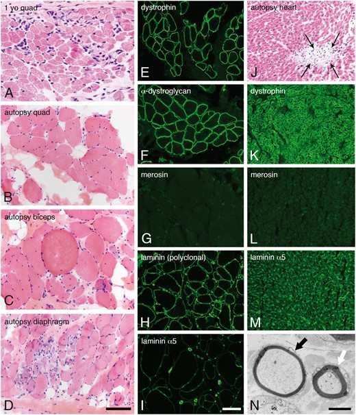 Skeletal muscle, heart, and sural nerve pathology. Dystrophic pathology was evident in H&E-stained cryosections from muscles evaluated as a diagnostic biopsy at age 1 year (A, quadriceps) or autopsy (B, quadriceps; C, biceps; D, diaphragm). Immunofluorescence studies performed in quadriceps obtained at autopsy showed normal expression of dystrophin (E) and α-dystroglycan (F, IIH6). In contrast, merosin was absent (G, 5H2 80 kDa antibody). Other isoforms of laminin were expressed in skeletal muscle basement membranes (H, polyclonal laminin antibody; I, laminin α5). Cardiac muscle evaluated at autopsy showed multifocal sites of lymphocytic aggregation, consistent with myocarditis (J, H&E). Immunofluorescence studies performed in the heart showed normal expression of dystrophin (K) but the total absence of merosin (L). Laminin α5 was strongly expressed (M). Abnormally thin myelin sheaths were noted by electron microscopy of the sural nerve (black arrow in N). The white arrow points to an axon with normal thickness myelin sheath. The scale bar in panel D is 100 µm for panels A–D and J–M; the scale bar in panel I is 100 µm for panels E–M. The scale bar in panel N is 2 µm. H&E, hematoxylin and eosin.