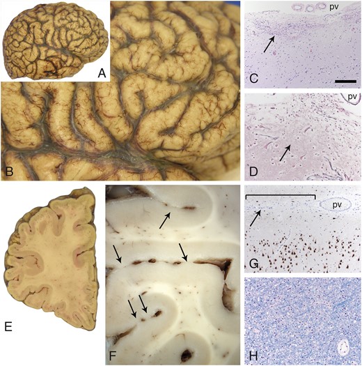 Cobblestone pathology in the cerebral cortex. The surface contour of the cerebral cortex was pebbled in a diffuse, relatively symmetric distribution that affected all lobes in both hemispheres (A, B). Multifocal sites of dense gliosis were noted along the cerebral cortical surface (C, arrow, H&E stain; pv). A reticulin stain (D) revealed that the pial surface basement membrane was disrupted at these sites of gliosis (arrow). Large, dysmorphic neurons (either side of the arrow, D) were often present at these sites. Coronal sections further revealed that adjacent gyri were partially fused across the intervening sulci (E and F, arrows; left frontal lobe). Superficially displaced neurons were also evident with neuN immunoperoxidase staining (G); subtle abnormal clustering of neurons was also often present within upper layers of the cortex. The bracket in G marks a region of fusion between adjacent gyri; the arrow points to the sulcus. A pv is present within the sulcus. White matter from multiple sites was unremarkable (H, LFB stain; frontal lobe centrum semiovale). The scale bar in panel C is 200 µm for panels C and G, and 100 µm for panels D and H. H&E, hematoxylin and eosin; LFB, luxol fast blue; pv = pial surface vessels.