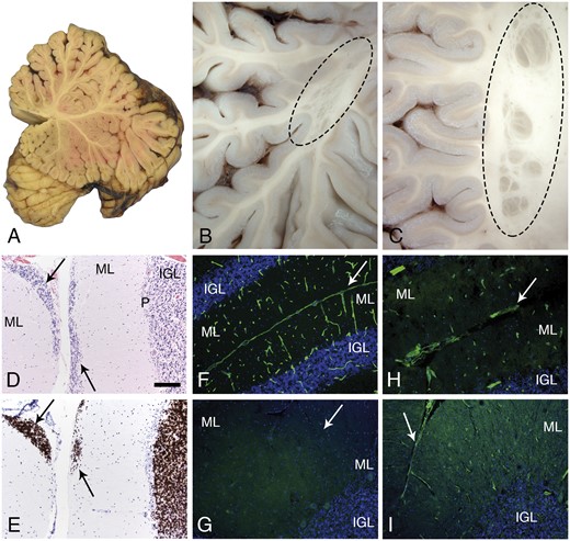 Cerebellar pathology. A mid-sagittal section of the cerebellum showed normal gross morphology (A). In contrast, several examples of subcortical, heterotopia was observed in the hemispheres (B, C; oval dashed lines). Microscopic evaluation revealed sites of failed external granule cell migration (arrows in D, H&E and E, neuN; IGL, P, ML). Immunofluorescence staining of cryosections revealed merosin at the pial surface basement membrane and perivascular basement membranes of control cerebellum (F); merosin was absent from the patient’s cerebellum (G; arrow marks the position of a sulcus). Other laminins were present at the patient’s pial surface and perivascular basement membranes (H, polyclonal laminin, α1 subunit on laminin-111; I, laminin a5). Arrows in H and I mark the position of sulci. The pial surface basement membrane was interrupted at some sites (H). The scale bar in panel D is 100 µm for panels C–I. H&E, hematoxylin and eosin; IGL, internal granule cell layer; ML, molecular layer; P, Purkinje cell layer.