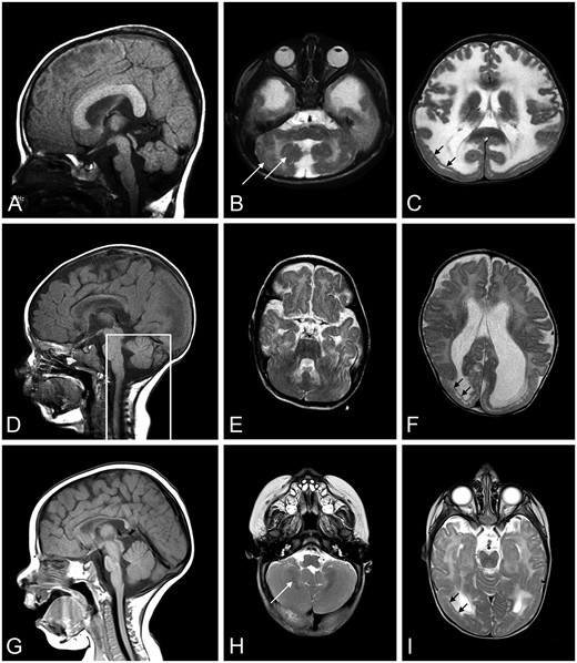 Brain MRIs from Patients 2, 3, and 4. A T2-weighted brain MRI was done for Patients 2 (A: sagittal, B, C: axial), 3 (D: sagittal, E, F: axial), and 4 (G: sagittal, H, I: axial). MRI at 18 months of age showed short brain in the antero-posterior direction (A), pontine hypoplasia and cerebellar vermis with cerebellar cortical dysplasia (B, white arrows), and temporal-occipital cobblestone malformation (C, black arrows) with frontal polymicrogyria in Patient 2. MRI at 8 months of age illustrate posterior-occipital malformation (D–F) in Patient 3. The box outlining posterior fossa structures designates a mid-sagittal image of these structures; they were not mid-sagittal in the image shown for the remainder of the brain. MRI at 6 months of age in Patient 4 showed occipital malformation (G–I), cerebellar cortical dysplasia (H), and T2 hyperintensity in the periventricular white matter (I). MRI, magnetic resonance imaging.
