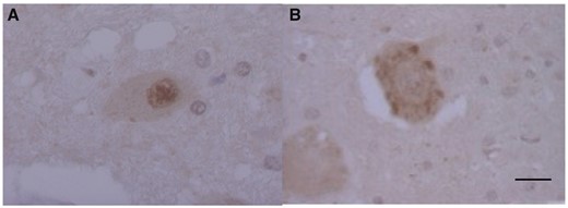 Phosphorylated transactivation-responsive DNA-binding protein 43-positive neuronal cytoplasmic inclusions (NCIs) in the lower motor neurons in Spinocerebellar ataxia type 2. Subcellular TDP-43 and pTDP-43 immunoreactivity: TDP-43-ir (A) and pTDP-43-ir (B) in the motor neurons of the anterior horn. Scale bars: 10 µm.