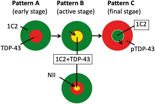 Nuclear clearing of transactivation-responsive DNA-binding protein 43 may be complementary to nuclear accumulation of expanded polyglutamine. The figure shows the schema of 3 patterns of 1C2 and TDP-43 pathology in SCA2. 1C2-positive expanded polyglutamine (green) is initially present only in the cytoplasm (pattern A) and extends into the nucleus (pattern B), occasionally accompanied by nuclear inclusions (pattern B+). Next, 1C2 accumulates only in the nucleus (pattern C), as we have already reported (15). By contrast, normal nuclear TDP-43 (red, patterns A and B) is cleared when 1C2-positive expanded polyglutamine accumulates in nucleus (pattern C). Patterns A, B, and C represent the early, active, and final stages of the disease, respectively.