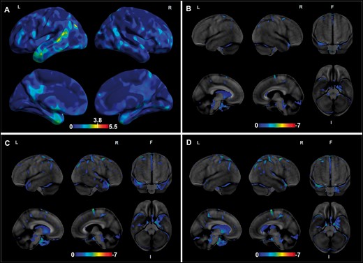 Volume loss and hypometabolism on neuroimaging. The effect map shows differences in gray matter volumes between the star-shaped TDP-43 group (n = 5) and the healthy control group (n = 12) (A). In the top lateral views, involvement of the anterior temporal pole and the posterosuperior temporal region is seen. In the bottom medial views, involvement of the medial temporal pole, precuneus and posterior cingulate are evident. The color bar represents height threshold T-values ranging from 0 (blue) to 5.5 (red). Regions that showed significantly less gray matter volumes in the star-shaped TDP-43 group at p < .001 are those with T > 3.78 (dark yellow to red). (B–D) Results from longitudinal FDG-PET scans (taken 2 years apart) from 1 case (case 4) showing progressive left medial temporal lobe hypometabolism. Abbreviations: FDG-PET, 18F-fluorodeoxyglucose-positron emission tomography; F, front; I, inferior; L, left; R, right.