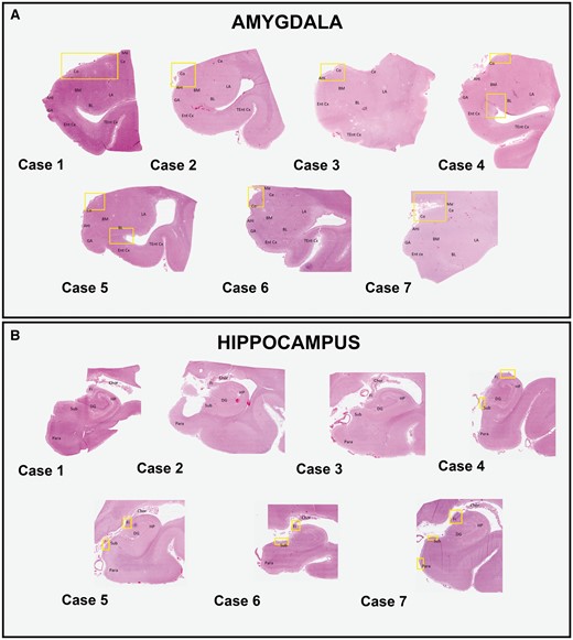 Distribution of TDP-43-immunoreactive inclusions. Whole slide imaging of digitalized sections from the amygdala (A) and hippocampus (B) are shown. To easily identify anatomical regions, sections stained with hematoxylin and eosin from each patient are selected. The amygdaloid subregions are labeled. Areas where the star-shaped TDP-43 inclusions are observed in the amygdala are delineated by the yellow boxes (A). These mainly involve the corticomedial regions in all cases and additionally the basolateral white matter and subependymal regions in case 4 and 5. Areas where the thread-like neurites are seen in the hippocampal regions are similarly delineated by the yellow boxes (B). These include the fibers of the fimbria and the subiculum in all cases, with the addition of the entorhinal cortex in case 7. Abbreviations: Ahi, amygdala hippocampal transition area; BL, basolateral nucleus; BM, basomedial nucleus; Ce, central nucleus; Chor, choroid plexus; Co, cortical nucleus; DG, dentate gyrus; Ent cx, entorhinal cortex; Fi, fimbria; GA, gyrus accumbens; HP, hippocampal proper; LA, lateral nucleus; Me, medial nucleus; Para, parahippocampal gyrus; Sub, subiculum; Tent cx, transentorhinal cortex.