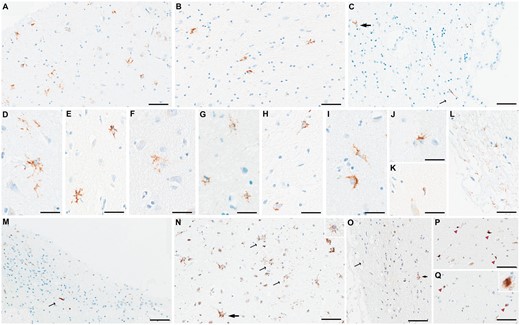 Representative figures of microscopic TDP-43 findings. Amygdala slides stained with antibodies against phospho-TDP-43 showed star-shaped TDP-43-immunoreactive inclusions in medial subpial regions (A) and basolateral white matter (B) and subependymal regions (thick arrow in C). Additionally, dot-like neuropil (A) and a long thread-like neurite (thin arrow in C) are seen. Different morphologies of star-shaped inclusions are shown: star-shaped with long, branching processes (D, E), with lace-like processes (F), with granular appearance (G, H), or with crown-like (I) or thorn-like (J) appearance. An occasional coiled body-like inclusion is shown (K). Superficial thin, thread-like neurites are commonly seen (L). In the hippocampus, a variety of neurites from thin to thick and short to long are seen in the fimbria (M), as well as the subiculum and entorhinal cortex (not shown). Using antibodies against N-terminal TDP-43 (N), star-shaped TDP-43 inclusions with long processes are also seen (thick arrow), although many of the inclusions are more granular in appearance (thin arrows and inset in N). Using antibodies against the C-terminal region (O), only a few granular star-shaped inclusions are seen (thick arrow) and some superficial neurites (thin arrow). However, some comma-shaped thick neurites (pink arrowheads in P) and neuronal cytoplasmic inclusions (pink arrowheads and inset in Q) are additionally seen. Scale bars: A-C, M-Q = 40 μm, D-K and all insets = 30 μm.