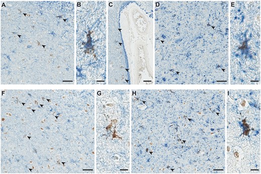 Representative images of double-labeling immunohistochemistry findings. Double-labeling immunohistochemistry showed colocalization of pTDP-43 (brown: Rb3655) and GFAP (blue: GA-5) within the star-shaped inclusions in subpial (indicated by arrowheads in (A) and magnified inclusion in (B)) and perivascular regions (indicated by black arrowheads in (C)). Double labeling immunohistochemistry for pTDP-43 (brown: Rb3655) and phospho-tau (blue: CP13) also showed colocalization of the 2 proteins in the star-shaped inclusions (arrowheads in (D) and magnified inclusion in (E)). Similar colocalizations are seen using anti-nTDP-43 antibodies (brown: MC2079) and anti-GFAP (blue: GA-5) in panels (F) and (G), as well as using anti-nTDP-43 (brown: MC2069) and anti-phospho-tau (blue: CP13) in panels (H) and (I). Scale bars: A, C, D, F, H = 40 μm, B, E, G, I = 10 μm. Abbreviation: GFAP, glial fibrillary acidic protein.