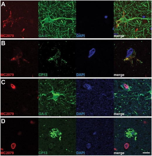 Representative images of double-labeling immunofluorescence findings. Double-labeling immunofluorescence (red: MC2079, green: GFAP) shows localization of TDP-43 within astrocytes (A). Similarly, double-staining immunofluorescence with MC2079 (red) and CP13 (green) showed colocalization of TDP-43 and tau within the atypical inclusions (B). No star-shaped TDP-43 pathologic inclusions localized in astrocytes (C) or colocalizing with tau (D) are seen with the negative control case. Scale bar = 10 μm. Abbreviation: GFAP, glial fibrillary acidic protein.