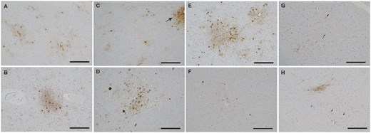 Neocortical phosphorylated tau pathology in the CTE-NC cases. (A, B) Case 1 (A) with high CTE-NC and Case 2 (B) with indeterminate staging of CTE-NC, visible as aggregates of neuronal and astroglial tau in a perivascular distribution in neocortex; subcortical neuronal tau deposition was also significant (not shown). (C, D) Case 3 (indeterminate CTE-NC) with abnormal neuronal and astroglial tau aggregates in the temporal lobe adjacent to evidence of subpial aging-related tau astrogliopathy (ARTAG, arrow) (C) and in the locus coeruleus (D). (E-H) Cases 4 (E), 5 (F), 6 (G), and 7 (H) with lesser but distinct perivascular neocortical tau deposition indicative of low CTE-NC. Abbreviation: CTE-NC: chronic traumatic encephalopathy-neuropathologic change. Scale bar = 200 µm.