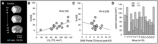 Correcting for edema in MRI images accurately estimates lesion volume; Garcia Neuroscore Scale (GNS) values do not correspond to the corrected LV. (A) The left/right hemispheric ratio (L/R ratio) was used to estimate the swelling of the left hemisphere affected by acute ischemic stroke (AIS). Note the shift of the midline and the expansion of the left hemisphere. (B) Tissue swelling or edema (increase in hemispheric volume due to space-occupying edema, %HSE) shows a linear relationship with lesion volume (LV) on T2 weighted MRI images (linear regression: R = 0.705, P = .003, P < 0.05). (C) Tissue swelling in MRI images shows no correlation with the GNS values measured 72 hours post-AIS (linear regression: R = 0.235, P = .398). (D) Edema correction provides a better estimation of true lesion volume (corrected lesion volume, LVc).