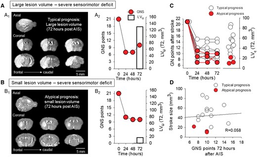 A subgroup of mice exhibited a paradoxical relationship between small lesion volume and severe neurological deficit. (A) A representative mouse with a typical prognosis displays a low Garcia Neuroscore Scale (GNS) score over the course of 72 hours of survival (A2), and a large lesion volume as measured on the T2-weighted MRI sequence (A1). (B) A mouse with severe neurological deficit (B2) was identified as having a poor prognosis and a small T2 lesion volume (B1). (C) Garcia Neuroscore Scale score assessed every 24 hours after AIS induction and corrected lesion volume (LVc) on day 3 are unrelated. (D) There was no linear relationship between lesion volume and GNS score assessed 72 hours after AIS (linear regression: R = 0.058, P = .837).