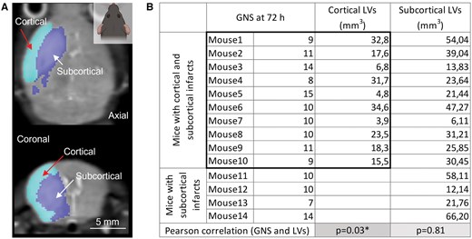 Cortical LVs show a linear relationship with neurological impairment 72 hours after stroke. (A) A representative axial (top) and coronal (bottom) T2 weighted sequence showing the semi-automated separation of cortical and subcortical infarcts. Light blue selection indicates cortical (red arrow), deep blue selection denotes subcortical (white arrow) infarcts. (B) The table shows the 2 subgroups of mice: (1) mice with cortical and subcortical LVs, and (2) mice with only subcortical LVs. Cortical LVs of mice with cortical and subcortical infarcts and the corresponding GNS scores at 72 hours are highlighted with a black rectangle. There was a linear relationship between cortical but not subcortical LVs and GNS scores assessed 72 hours after AIS (linear regression: R = 0.681, P = .03*).