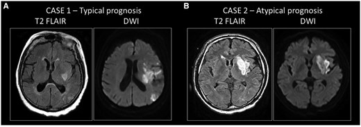 Clinical cases of typical and atypical prognosis in patients with ischemic stroke. (A) Case 1: typical prognosis in a patient with a large infarct volume with severe residual symptoms. An 81-year-old female patient was admitted with aphasia and severe right-sided hemiparesis. The National Institutes of Health Stroke Scale score at the initial examination was 14 points. The Alberta Stroke Programme Early CT score was 9/10. CT angiogram showed occlusion of the left middle cerebral artery (M1). The onset of symptoms was unknown. According to protocol, CT perfusion was performed, showing a large salvageable penumbra without core. Despite the favorable initial imaging results, after successful clot removal (eTICI 3), control MRI showed the development of a large infarct on both diffusion-weighted imaging (DWI) and FLAIR. National Institutes of Health Stroke Scale score at discharge was 22 points. The 90-day modified Rankin Scale (mRS) score, which is based on disability and dependence on activities of daily living following the stroke, was 5; the patient had severe residual symptoms. (B) Case 2: atypical prognosis in a patient with moderate infarct volume and severe residual symptoms. A 65-year-old male patient presented with aphasia and right-sided hemiparesis. The NIHSS at admission was 9 points. Alberta Stroke Programme Early CT Score score was 8/10. A CT angiogram showed occlusion of the left middle cerebral artery (M2). The onset of symptoms was unknown. According to protocol, CT perfusion was performed, showing a 54 ml penumbra and a small 4 ml core. Endovascular treatment was indicated and successfully performed (eTICI 3). Severe clinical progression was noted, with NIHSS 16 points at discharge, and a 90-day mRS of 5 points. The clinical data presented here were not collected specifically for this project. These patient data were selected for representative purposes for this article and were obtained from the database of the Department of Neurology, Albert Szent-Györgyi Health Centre, University of Szeged, under the supervision of Dr Nikoletta Szabó.