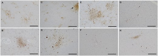 慢性的脳外傷の稀少性に関する研究(Mount Sinai Study Finds Chronic Traumatic Encephalopathy Rare Among Individuals With Isolated Brain Injuries) 慢性的脳外傷の稀少性に関する研究(Mount Sinai Study Finds Chronic Traumatic Encephalopathy Rare Among Individuals With Isolated Brain Injuries)