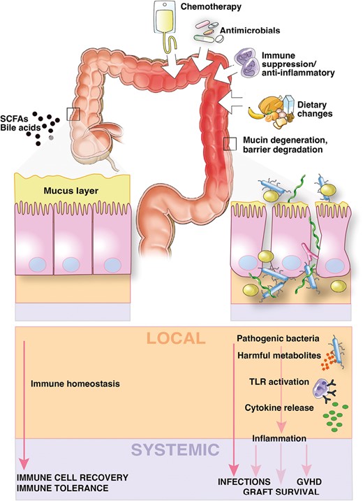 Key drivers of microbiome injury and microbiome–host interactions that influence outcomes after transplantation. In health (shown on the left), diverse gut microbes and microbial metabolites maintain epithelial barrier integrity, resist pathogen expansion, and promote host immune recovery and tolerance. During transplantation (shown on the right), dietary changes, antibiotics, and immunosuppressive medications alter the microbiome, leading to the loss of putatively beneficial bacteria and the expansion of potential pathogens that produce harmful metabolites that promote inflammation and alter the intestinal microenvironment. These changes leave the host susceptible to bacterial translocation and initiate an inflammatory cascade that can result in adverse outcomes of transplantation such as GVHD and graft failure. GVHD, graft-versus-host disease; SCFA, short-chain fatty acid; TLR, Toll-like receptor.