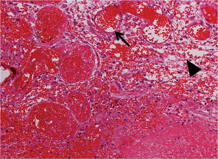 A hematoxylin and eosin (H&E)-stained specimen from Case 5. Thin-walled enlarged capillaries indicating telangiectasis (arrow) and the proliferation of arterioles can be seen in the area between the necrotic core and normal brain tissue. These blood vessels were accompanied by interstitial edema (arrowhead) due to plasma leakage. The original objective magnification was ×100.