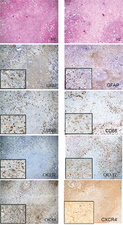 H&E staining and immunohistochemistry for GFAP, CD68, CXCL12 and CXCR4 of the surgical specimen from Case 2 in the left column and for Case 3 in the right column. H&E staining showed the necrotic core and the surrounding tissue (perinecrotic area). Immunohistochemical staining for GFAP, CD68, CXCL12 and CXCR4 revealed GFAP- and CXCL12-positive astrocytic cells, and CD68- and CXCR4-positive oval cells in the perinecrotic area. CD68- and CXCR4-positive cells were also observed in small numbers inside the necrotic core. On the other hand, no or scarce immunoreactivity of GFAP and CXCL12 was observed in the necrotic core. The original objective magnifications were ×40 and ×200.