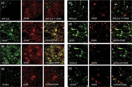 Double immunofluorescence staining of the specimen from Case 2. The expression of HIF-1α was not detected in reactive astrocytes, as revealed by GFAP (a), but was detected in CD68-positive cells (b). VEGF was expressed in GFAP-positive cells (c) but was hardly expressed in CD68-positive cells (d). Similarly, CXCL12 was expressed in GFAP-positive reactive astrocytes (e) but not in CD68-positive cells (f). In contrast, CXCR4 was not expressed in GFAP-positive cells (g) but was expressed in CD68-positive cells (h). The original objective magnification was ×400.