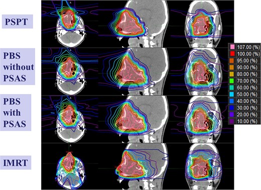 Comparisons of treatment planning for each irradiation method. Regarding proton therapy, dose calculation to guarantee the dose on the proximal side is necessary, and the stopping power of protons in the air is estimated from the CT number of air by the VQA planning system.