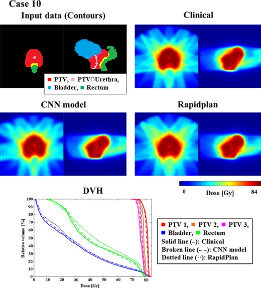 An example (Case 10) of similarly matched dose distributions predicted clinically and by CNN. ForDVHs, solid, broken, and dotted lines indicate dose distributions determined clinically and by the CNN model and RapidPlanTM, respectively.