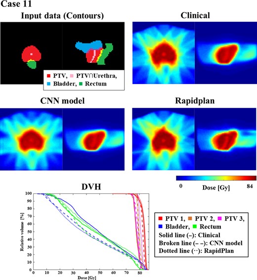 An example (Case 11) of similarly mismatched dose distributions predicted clinically and by CNN. For DVHs, solid, broken, and dotted lines indicate dose distributions determined clinically and by the CNN model and RapidPlanTM, respectively.