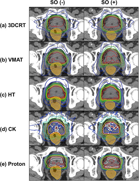 Typical dose distribution of SO(−) and SO(+) and the results of five modalities: (a) 3DCRT, (b) VMAT, (c) HT, (d) CK and (e) proton. The contour of the orange color illustrates the rectum.