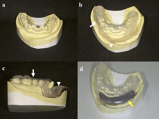 Schemata for the fabrication of spacers: (a) dental impression; (b, c) spacer made from a two-layer thermoforming plate (white arrow) and self-curing resin (white arrowhead); (d) spacer with shield made from lead (yellow arrow).