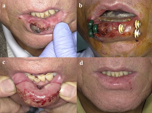 Photograph of patient with lower LC T2 SCC: (a) LC region before brachytherapy; (b) insertion of applicators; (c) 14 days after brachytherapy, acute mucositis on the lower lip observed only on the irradiated area; (d) 8 months after brachytherapy, the tumor resolved and no late complications occurred.