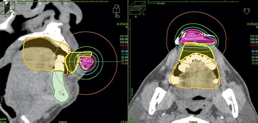 Treatment planning. The magenta line depicts the CTV, the orange line depicts the oral cavity, the green line depicts the mandible and the yellow line depicts a contour of the spacer. (Dose values were reference values because lead shield was used during actual treatment.)