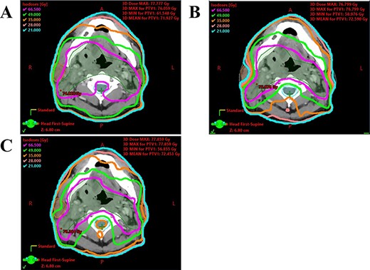 (A) KBP without manual objective constraints from a single optimization for right tonsil cancer, (B) KBP with manual objective constraints from a single optimization for the same patient, and (C) CMO plan for the same patient. Green line, 49 Gy iso-dose line; orange line, 35 Gy iso-doseline.