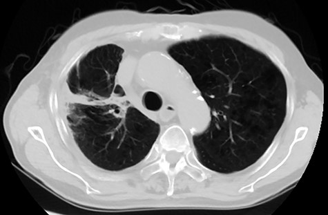 Follow-up computed tomography image of the same patient shown in Figure 1. Imaging was acquired 6 months from treatment. There was no evidence of recurrence and out-of-irradiated-field pneumonitis.