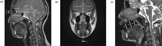 The anatomical structures in the head motion and tongue depressor measurement. The displacement indices were the maximum displacement (distance B) at the facial surface due to the head-up and -down motion and the maximum displacement (distance C) at the midline due to the head-left and -right motion. For the evaluation of the tongue depressor function, the distances from the hard palate to the apex of the tongue (distance D), from the hard palate to the anterior part of the dorsal surface of the tongue (distance E), from the hard palate to the posterior part of the dorsal surface of the tongue (distance F) and from the posterior pharyngeal wall to the root of the tongue at the uvula tip (distance G) were measured, respectively.
