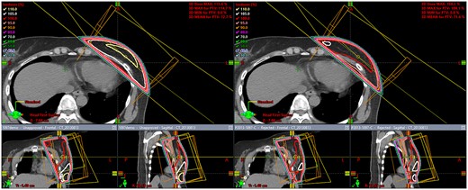 Comparison of dose distributions by tangential irradiation fields for the left breast with the field-in-field method (right) and without the field-in-field method (left).