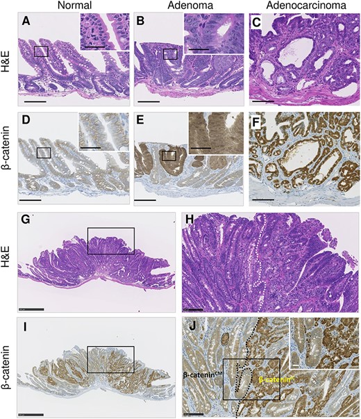 Representative histology and β-catenin immunostaining images of normal and neoplastic intestinal FFPE tissues. (A–C, G and H) H&E staining. (D–F, I and J) β-catenin immunostaining. (G–I) Histology of a representative adenocarcinoma. Insets in A–F are magnified views of the rectangles. (H and J) Enlarged images of rectangles in G and I, respectively. The dotted line indicates the boundary between the β-cateninIC and β-cateninCM regions. Scale bars, 100 μm (A–F, H and J), 25 μm (insets) and 500 μm (G and I).