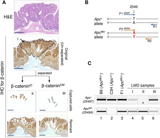 Immunoguided LMD approach for cell collection and analysis of Apc+ allele loss. (A) Guided by the nuclear accumulation of β-catenin, LMD was used to collect cells in the unseparated (I), β-cateninIC (II) and β-cateninCM (III) regions. IHC = immunohistochemical staining. (B) Primer set used to detect Apc+ and ApcMin alleles. (C) LOH results showing loss of Apc+ in the β-cateninIC region (asterisk). Lanes 1–3, ear-skin DNA from B6 ApcMin/+ , C3H Apc+/+ and C3B6F1 ApcMin/+ mice; lanes 4–6, samples corresponding to I, II and III in A. Results are representative of five tumors. Scale bars, 250 μm (A).