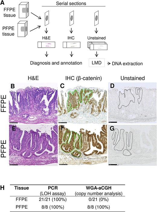Effect of the formalin-free fixative PAXgene on tissue staining and DNA quality. (A) Staining and DNA extraction strategy using FFPE and PFPE samples. IHC = immunohistochemical staining. (B–G) Serial sections were used for diagnosis on H&E staining (B and E), β-catenin immunostaining (C and F) and DNA isolation without staining (D and G). Dotted lines in C, D, F and G identify the β-cateninIC regions. (H) Summary of detection sensitivity of LOH and copy number variants at the Apc locus. Scale bars, 100 μm (B–G).